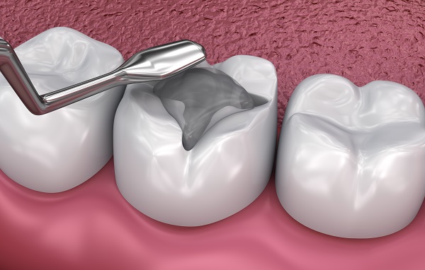 3 Ways That a Dental Filling Can Improve Your Oral Health